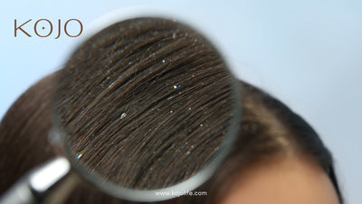 Dandruff: An often encountered hair issue in India